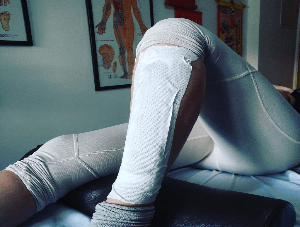 יעילות טיפול בשברים באמצעות דיקור סיני וצמחי מרפא – הצגת מחקרים