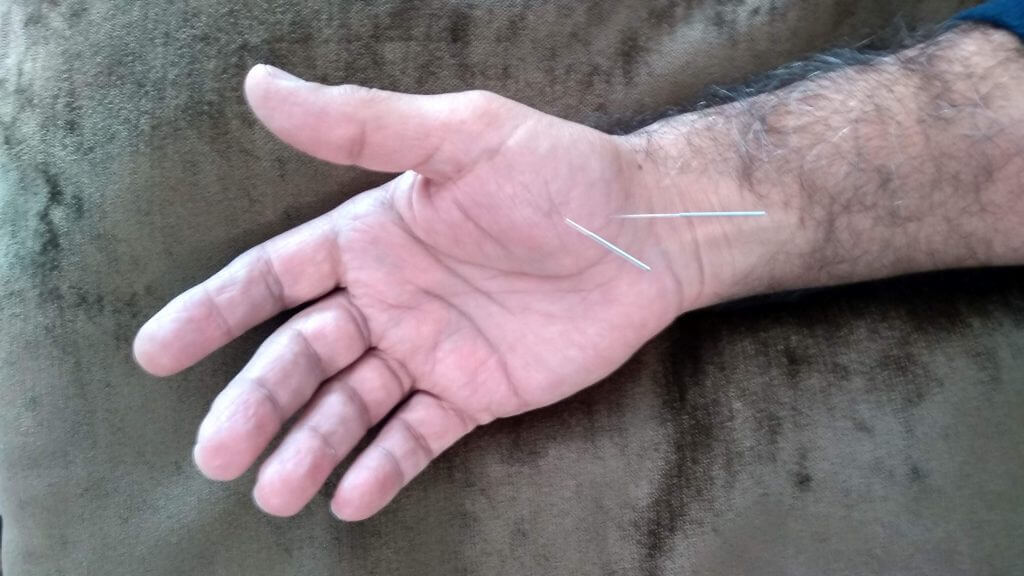 יעילותו של דיקור סיני בטיפול בדורבן – מחקר