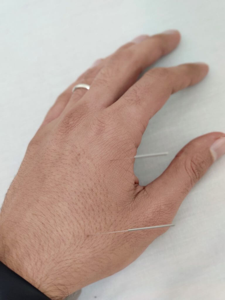 מגבלה פיזית ביום יום וכתף קפואה + מחקר