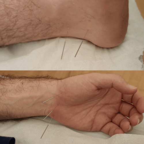 דיקור לדורבן ברגל דיקור לדורבן ברגל