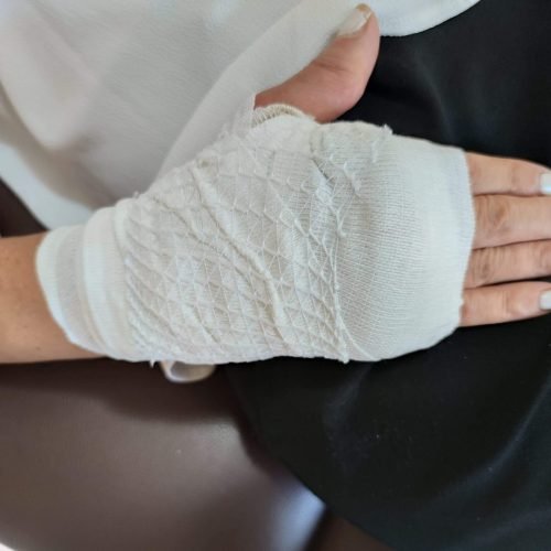 דלקת פרקים שגרונית