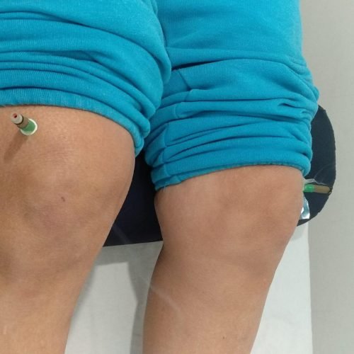 קונוסים של מוקסה לאוסטאוארטריטיס קונוסים של מוקסה לאוסטאוארטריטיס